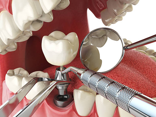 Best Emergency Dentist for Lost Fillings or Crowns in Kiawah Island, SC